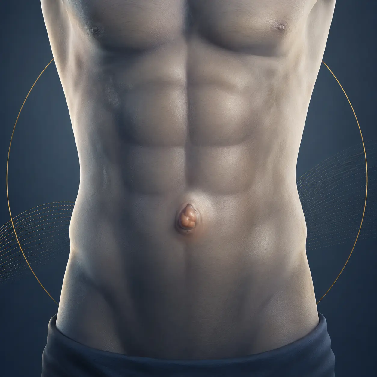 Representação anatômica de uma hérnia na parede abdominal